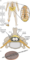 diagram of lower-limb stimulation and spinal cord stimulator leads
